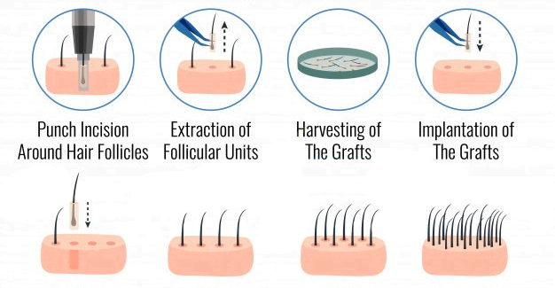 FUE hair transplant