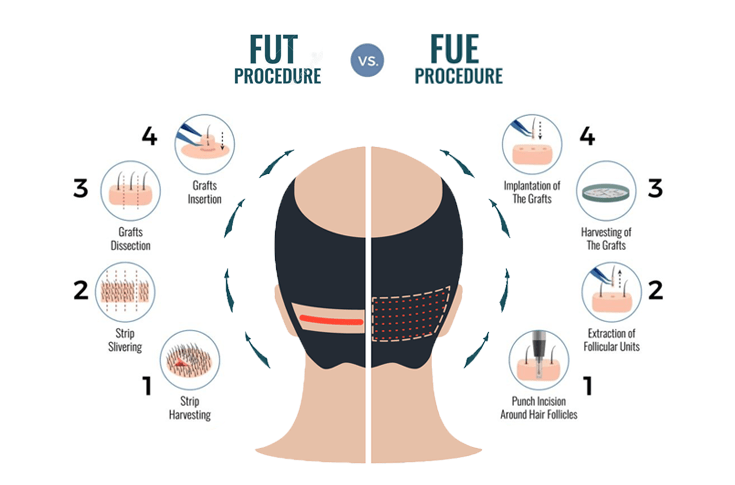 Hair transplantation technique