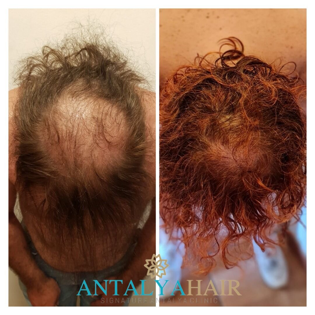 hair transplant antalya before after 1