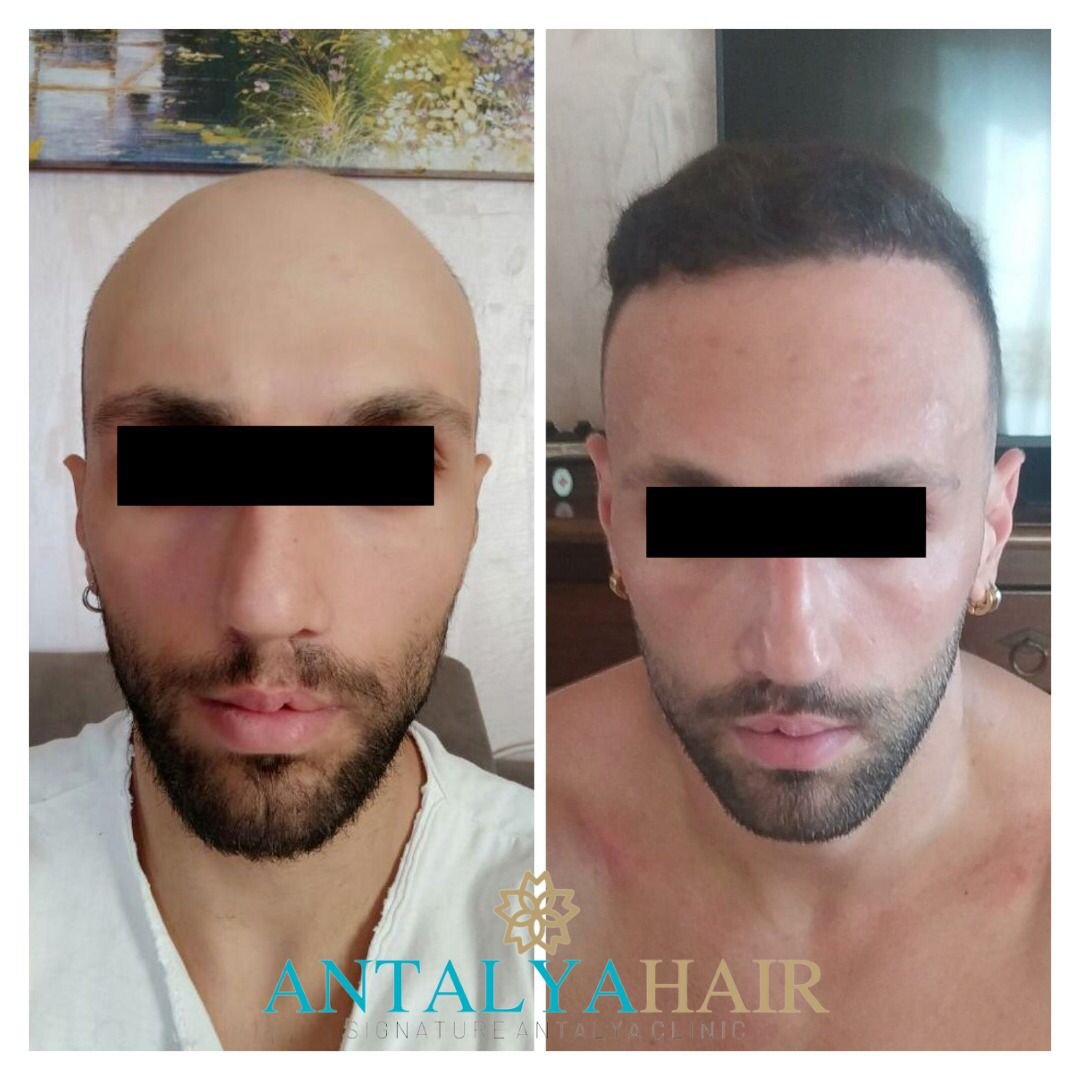 hair transplant antalya before after 2