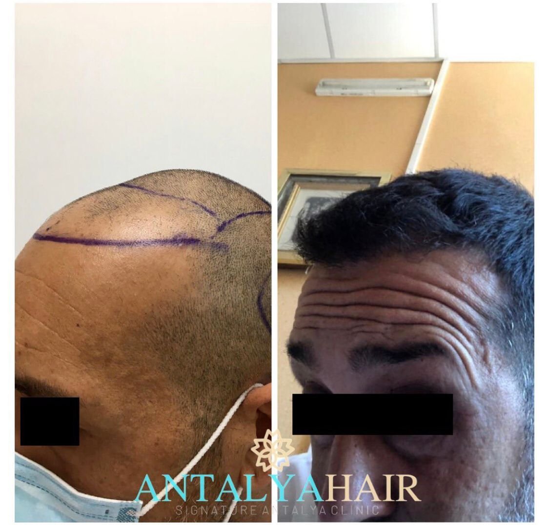 hair transplant antalya before after 3