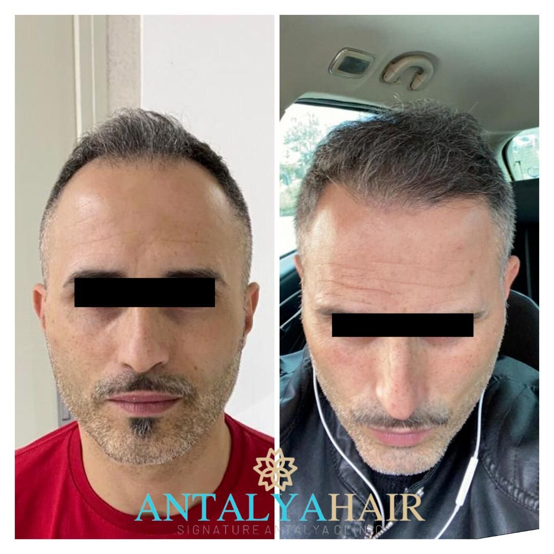 hair transplant antalya before after 4