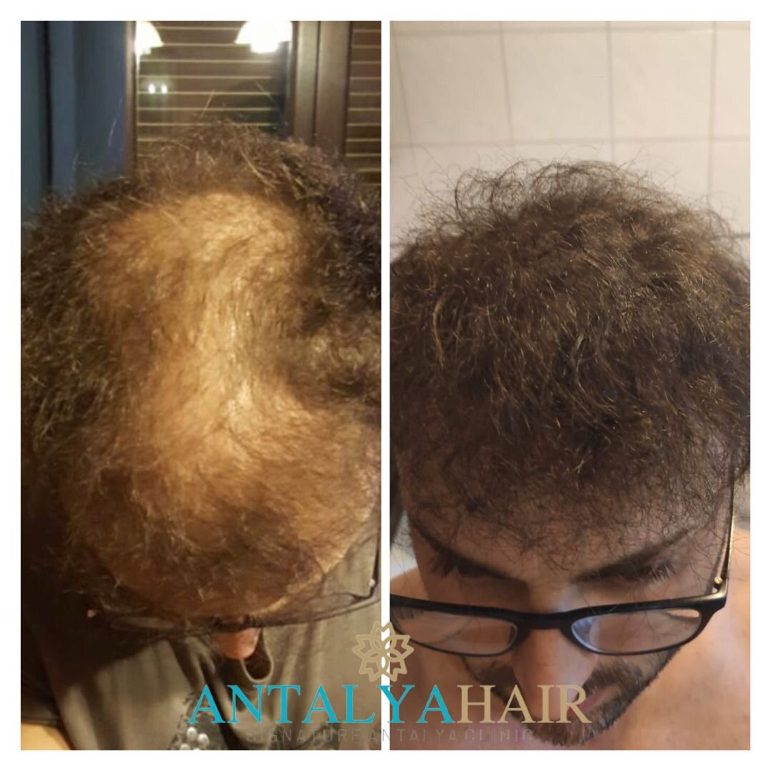 hair transplant antalya before after 5