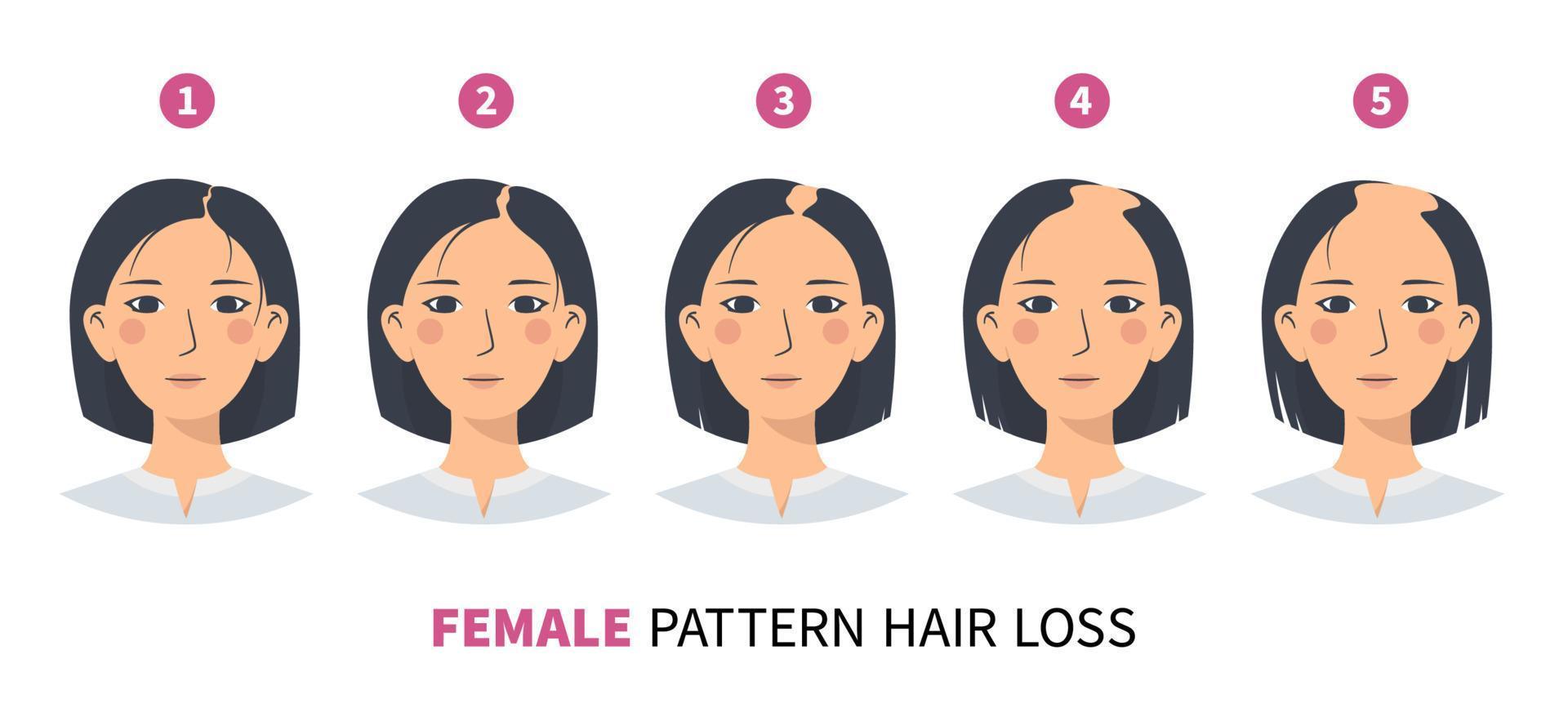 Causes of Hair Loss in Women and Treatment Options 3 hair loss pattern baldness in women