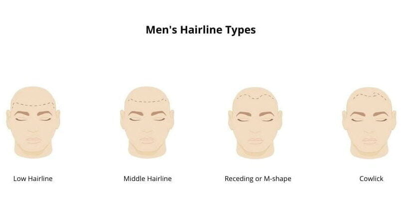 A Guide To The Different Types Of Hairlines Estevitalya Hair