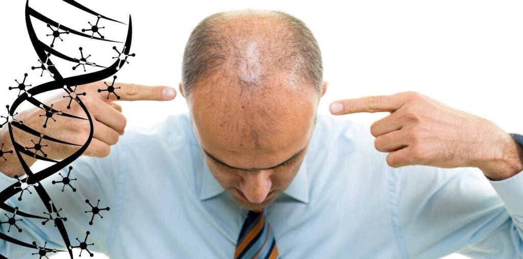 Understanding Hair Loss Genetics And Hair Transplants Estevitalya Hair