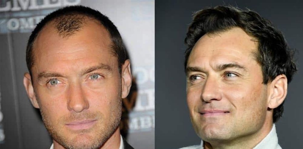 Jude Law Hair Transplant Before After