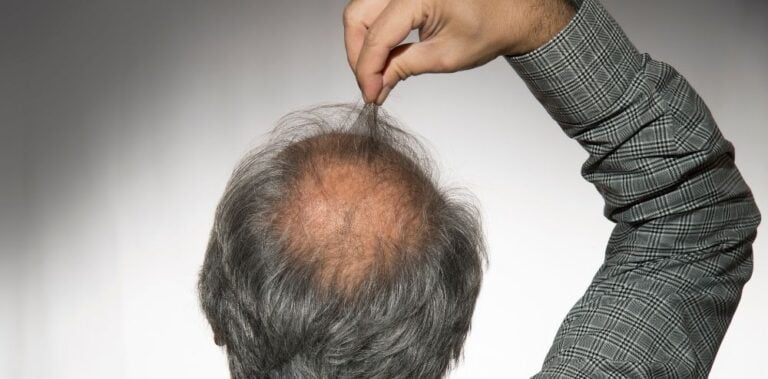 Do Hair Transplants Last Forever? The Truth About Hair Transplant 