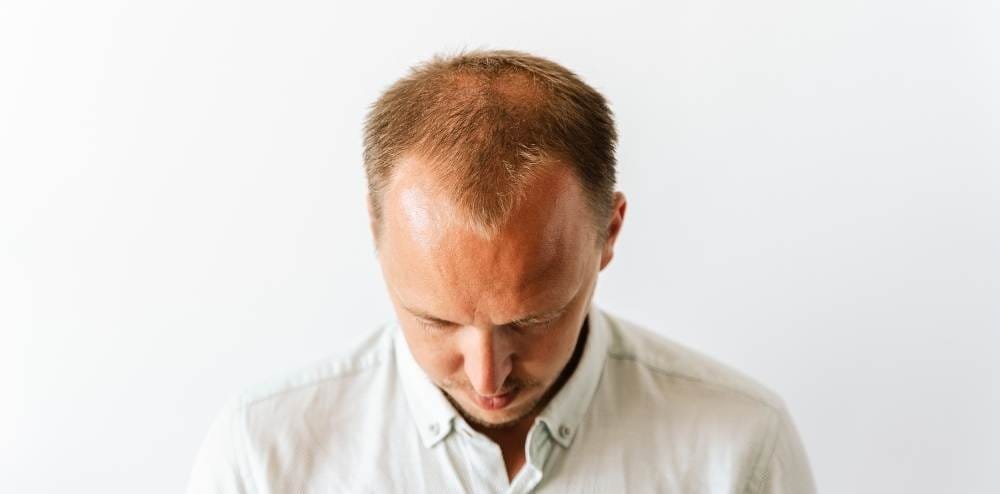 hair transplant natural